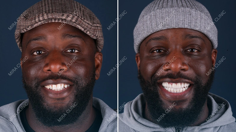 Dental implants Before and After